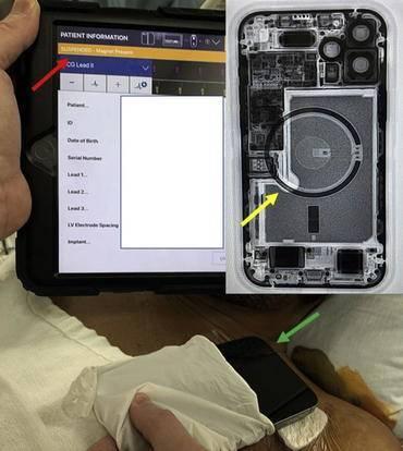 iPhone 12可能會影響植入式醫(yī)療設(shè)備正常運(yùn)行